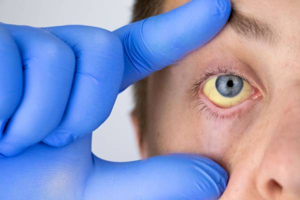 Close-up of a patient’s eye showing jaundice (yellow discoloration), being examined by a doctor wearing blue gloves.