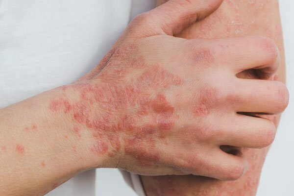 A close-up image of a hand and arm with red, scaly patches, indicating a common skin condition like eczema or dermatitis.