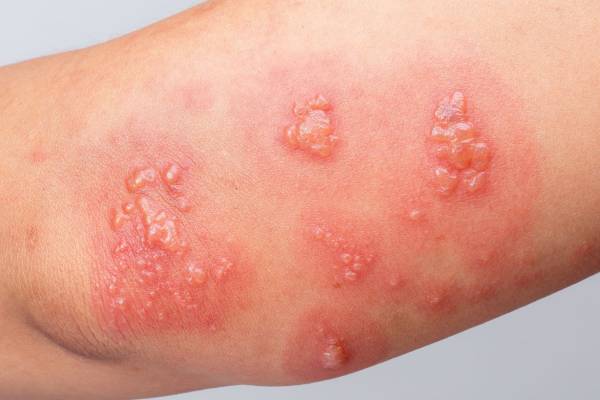 Close-up of a skin infection with red, inflamed blisters, indicating a viral or bacterial condition.